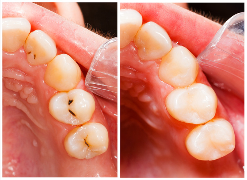 Fillings San Carlos, CA 