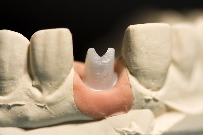Implant Restoration San Carlos, CA