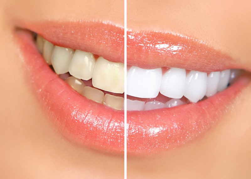 Teeth Whitening San Carlos, CA 